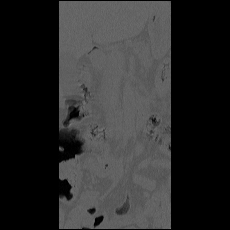 Acute Schmorl's node (Radiopaedia 83276-102365 Coronal bone window 3).jpg