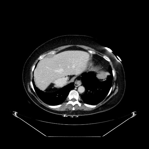 Acute appendicitis, heterotaxy syndrome (Radiopaedia 66884-76202 Axial C+ portal venous phase 20).jpg
