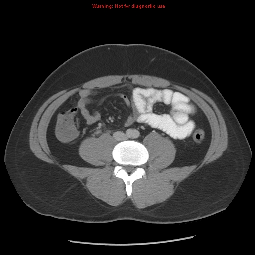 Acute appendicitis (Radiopaedia 10498-10973 Axial C+ portal venous phase 9).jpg