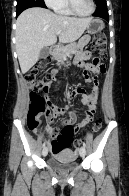 Acute appendicitis (Radiopaedia 22892-22918 Coronal C+ portal venous phase 18).png