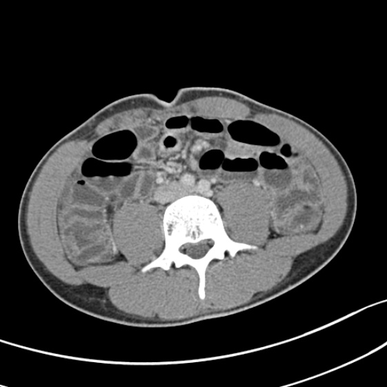 File:Acute appendicitis (Radiopaedia 32614-33572 Axial C+ portal venous phase 37).jpg