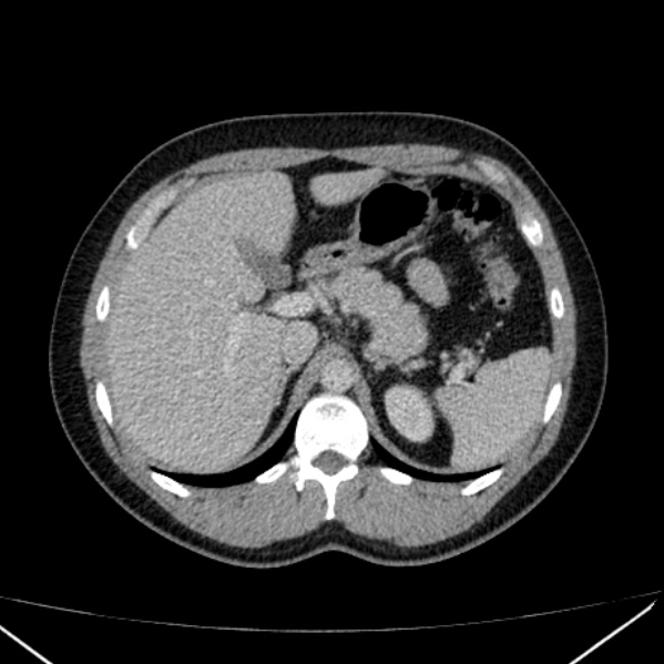 Acute appendicitis (Radiopaedia 38255-40270 Axial C+ portal venous phase 25).jpg
