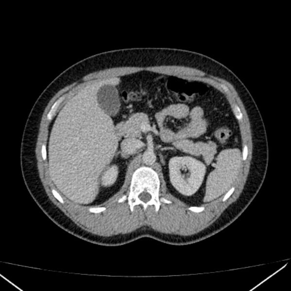 File:Acute appendicitis (Radiopaedia 38255-40270 Axial C+ portal venous phase 32).jpg