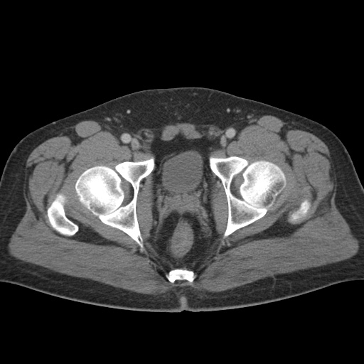 Acute appendicitis (Radiopaedia 48511-53463 Axial C+ portal venous phase 98).jpg
