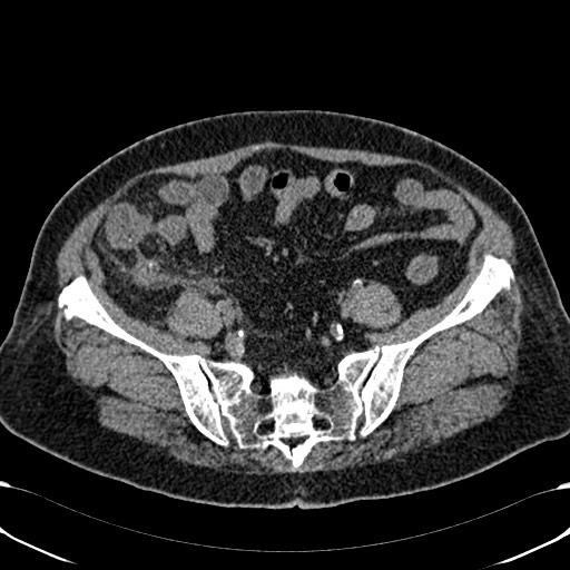 Acute appendicitis (Radiopaedia 58627-65818 Axial non-contrast 66).jpg