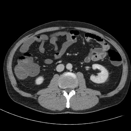 Acute appendicitis (Radiopaedia 66513-75790 Axial C+ portal venous phase 36).jpg