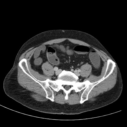 File:Acute appendicitis (Radiopaedia 66513-75790 Axial C+ portal venous phase 64).jpg