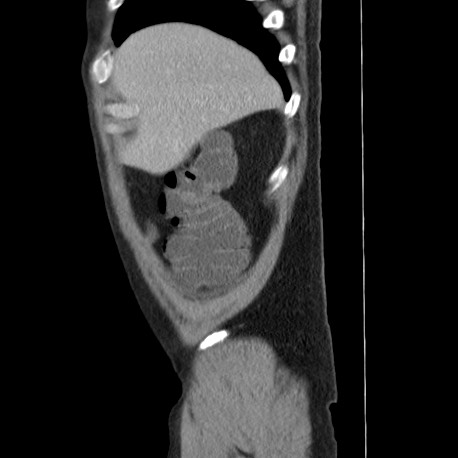 Acute appendicitis (Radiopaedia 66513-75790 Sagittal C+ portal venous phase 13).jpg
