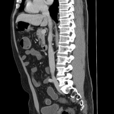 Acute appendicitis (Radiopaedia 66513-75790 Sagittal C+ portal venous phase 74).jpg