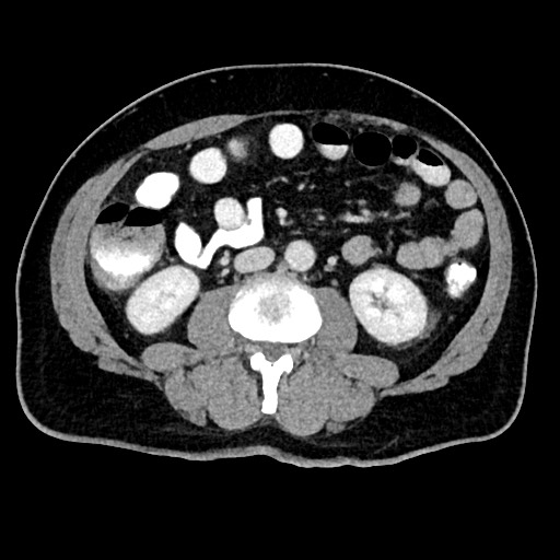 Acute appendicitis (Radiopaedia 77016-88960 Axial C+ portal venous phase 73).jpg