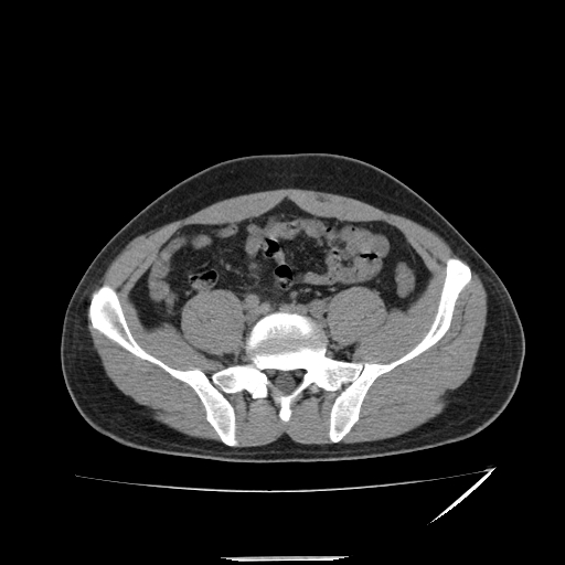 File:Acute appendicitis (Radiopaedia 81320-95015 A 6).jpg