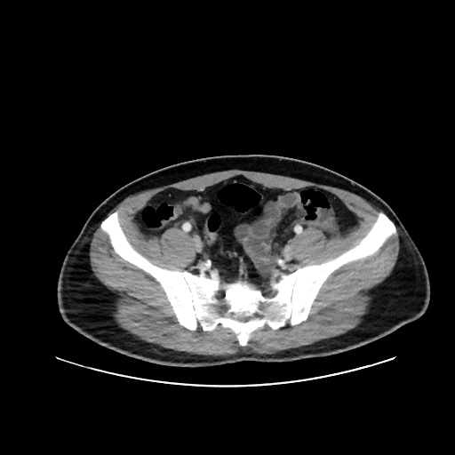 Acute appendicitis and COVID 19 pneumonia (Radiopaedia 76604-88380 Axial C+ portal venous phase 66).jpg