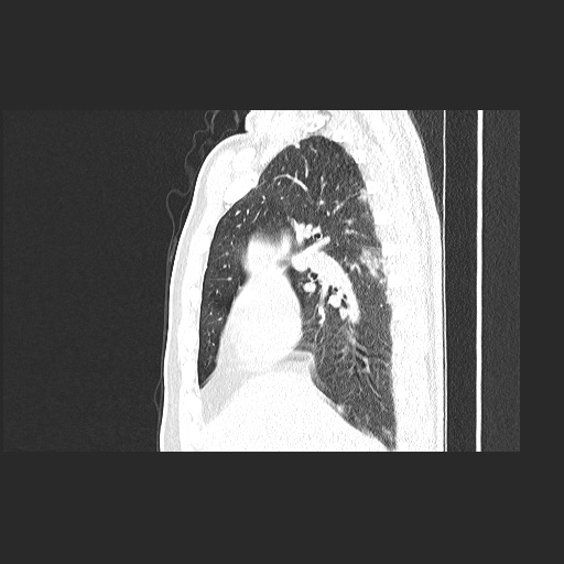Acute appendicitis and COVID 19 pneumonia (Radiopaedia 76604-88380 Sagittal lung window 35).jpg