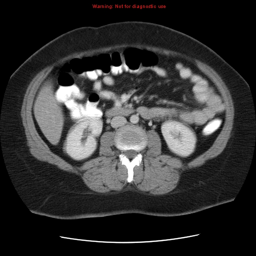 File:Acute appendicitis complicated by ovarian vein thrombophlebitis (Radiopaedia 16172-15851 Axial C+ portal venous phase 47).jpg