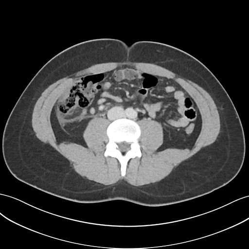 File:Acute appendicitis with appendicoliths (Radiopaedia 50186-55532 Axial C+ portal venous phase 45).png