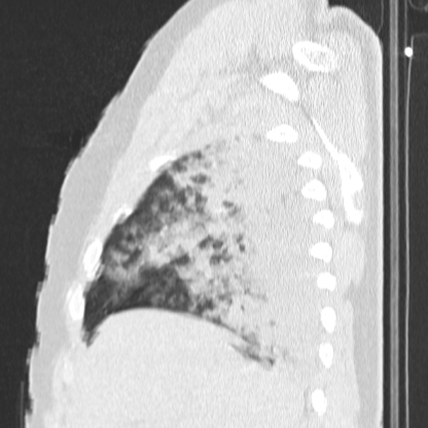 Acute aspiration pneumonitis (Radiopaedia 33605-34703 Sagittal lung window 21).jpg