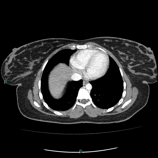 Acute bilateral pyelonephritis (Radiopaedia 37146-38881 Axial C+ portal venous phase 2).jpg
