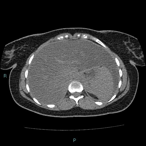 Acute bilateral pyelonephritis (Radiopaedia 37146-38881 Axial non-contrast 19).jpg