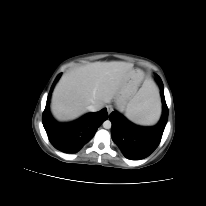 File:Acute calculous cholecystitis in patient with osteopetrosis (Radiopaedia 77871-90159 Axial C+ portal venous phase 18).jpg