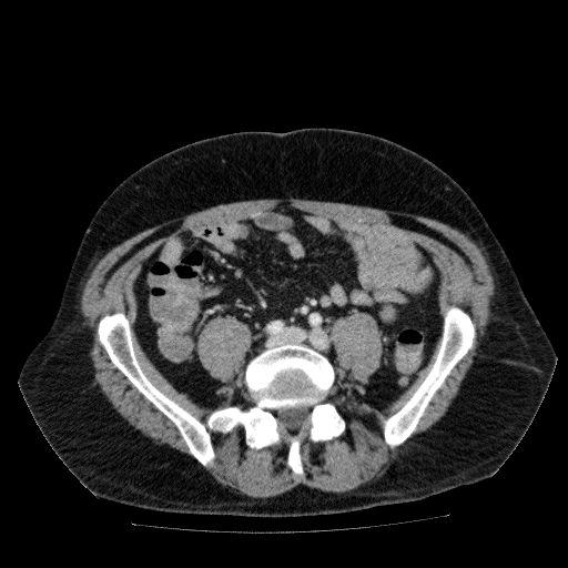 File:Acute cholecystitis and incidental left sided IVC (Radiopaedia 49352-54459 Axial C+ portal venous phase 104).jpg