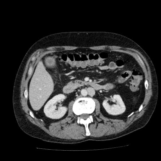 File:Acute cholecystitis and incidental left sided IVC (Radiopaedia 49352-54459 Axial C+ portal venous phase 68).jpg