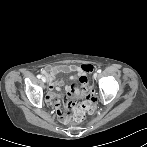 Acute cholecystitis with contained perforation (Radiopaedia 47328-51907 Axial C+ portal venous phase 63).png