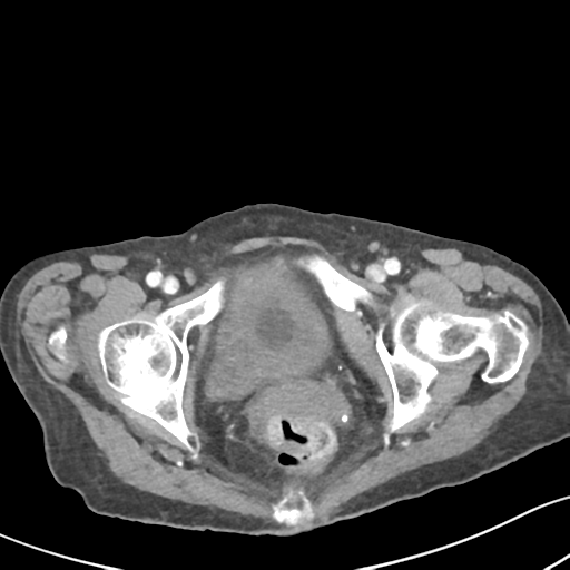Acute cholecystitis with contained perforation (Radiopaedia 47328-51907 Axial C+ portal venous phase 70).png