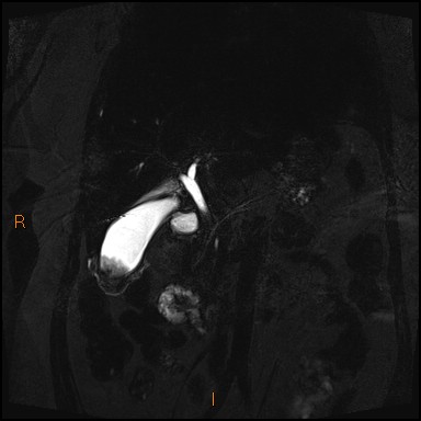 File:Acute cholecystitis with gallbladder neck calculus (Radiopaedia 42795-45971 Coronal Turbo spin echo 26).jpg