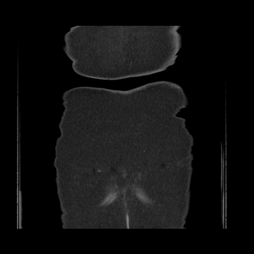 Acute cholecystitis with tensile fundus sign (Radiopaedia 71394-81723 Coronal non-contrast 122).jpg
