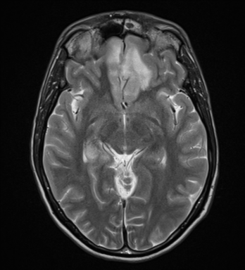 File:Acute disseminated encephalomyelitis (ADEM) (Radiopaedia 65319-74349 Axial T2 18).png