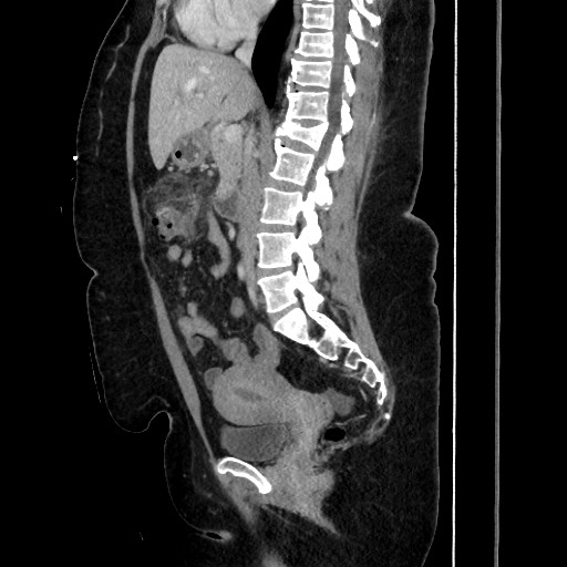Acute diverticulitis - transverse colon (Radiopaedia 87063-103327 Sagittal C+ portal venous phase 115).jpg