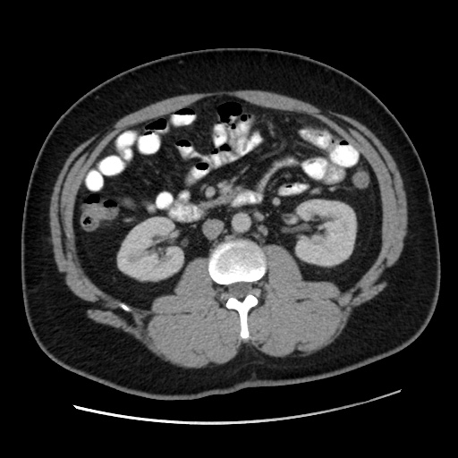 File:Acute diverticulitis with localized perforation (Radiopaedia 41296-44113 Axial C+ portal venous phase 42).jpg