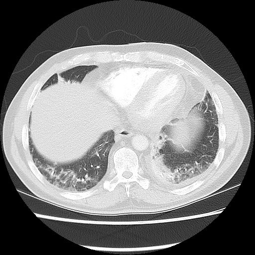 Acute epicardial fat necrosis (Radiopaedia 42327-45440 Axial lung window 43).jpg