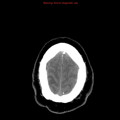 Acute hemorrhagic leukoencephalitis (Radiopaedia 14076-13920 Axial non-contrast 46).jpg