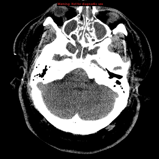 Acute hemorrhagic leukoencephalitis (Radiopaedia 14076-43697 Axial non-contrast 9).jpg