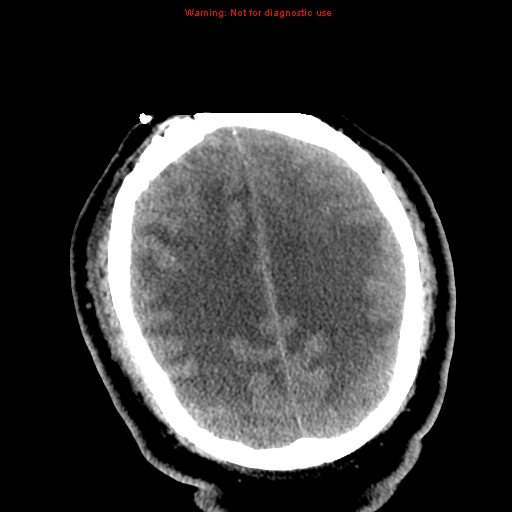 File:Acute hemorrhagic leukoencephalitis (Radiopaedia 14076-72275 Axial non-contrast 30).jpg