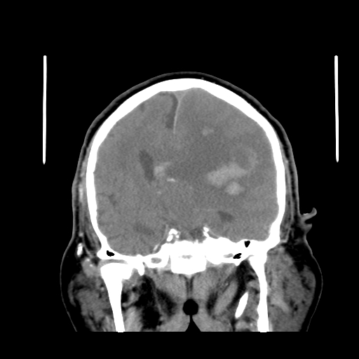 Acute hemorrhagic stroke (Radiopaedia 17507-17223 Coronal non-contrast 26).jpg