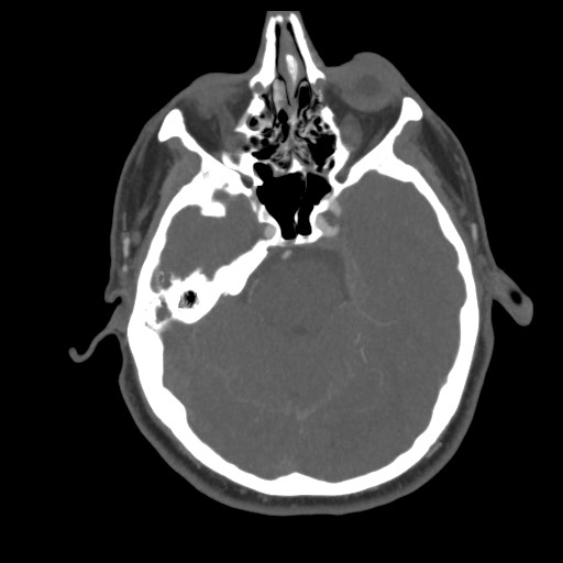 File:Acute internal carotid artery dissection (Radiopaedia 53541-59630 D 26).jpg
