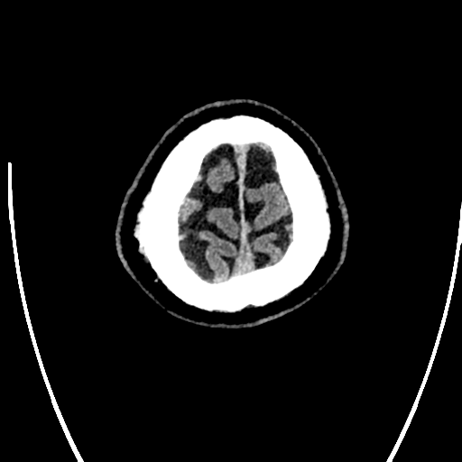 File:Acute left middle cerebral artery territory ischemic stroke (Radiopaedia 35688-37223 Axial non-contrast 83).png