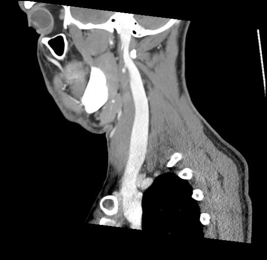 Acute longus colli calcific tendinitis (Radiopaedia 72495-83036 Sagittal C+ arterial phase 50).jpg