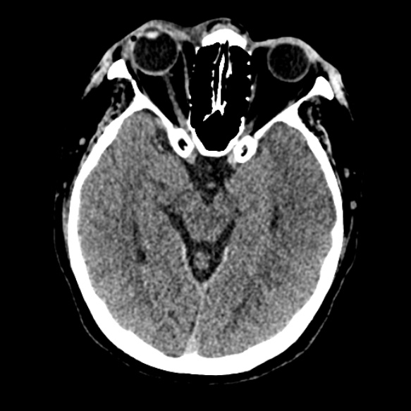 Acute middle cerebral artery territory infarct (Radiopaedia 52380-58283 Axial non-contrast 39).jpg