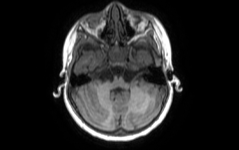 Acute necrotizing encephalitis of childhood (Radiopaedia 67356-76737 Axial T1 74).jpg