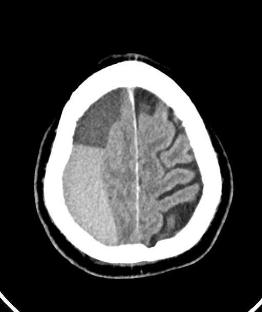 Acute on chronic subdural hematoma (Radiopaedia 78346-90966 Axial non-contrast 48).jpg