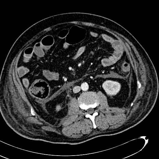 File:Acute pancreatic necrosis (Radiopaedia 13560-13486 Axial C+ portal venous phase 83).jpg