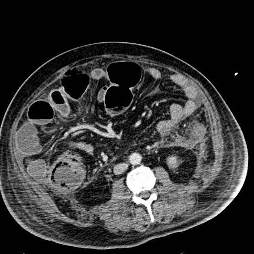Acute pancreatic necrosis (Radiopaedia 13560-18501 Axial C+ portal venous phase 79).jpg