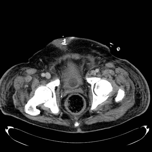 Acute pancreatic necrosis (Radiopaedia 13560-18503 Axial C+ portal venous phase 80).jpg