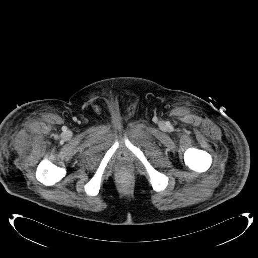 Acute pancreatic necrosis (Radiopaedia 13560-18503 Axial C+ portal venous phase 89).jpg