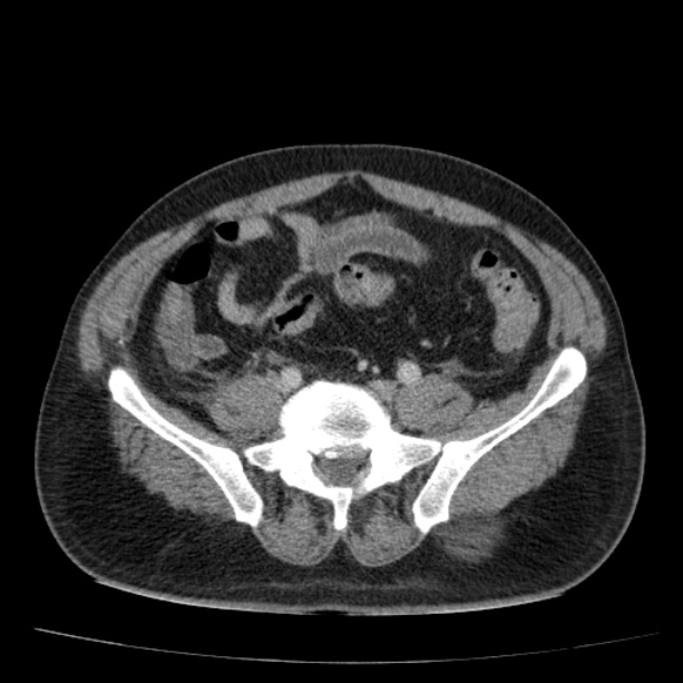 Acute pancreatitis (Radiopaedia 26663-26813 Axial C+ portal venous phase 62).jpg