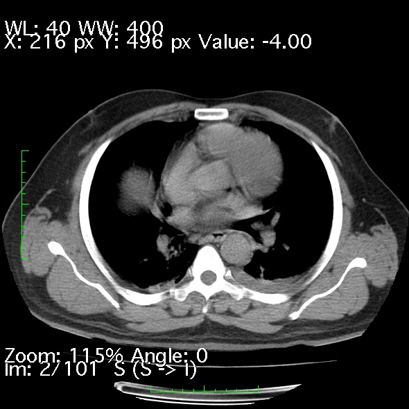 Acute pancreatitis (Radiopaedia 34043-35276 Axial non-contrast 2).jpg