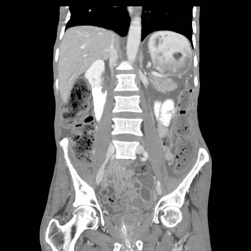 File:Acute pancreatitis (Radiopaedia 50213-55558 Coronal C+ portal venous phase 23).jpg